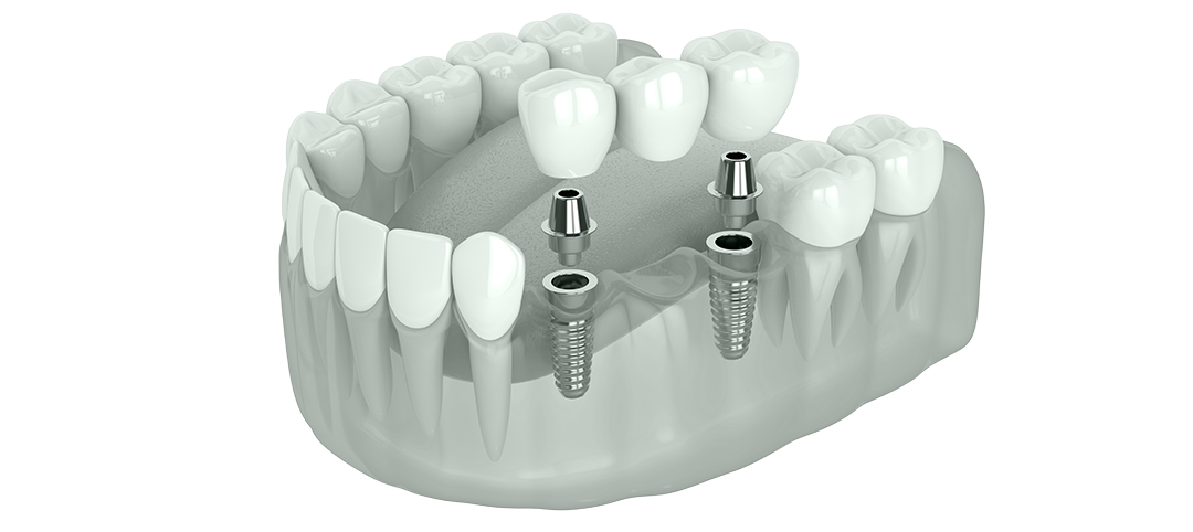 Zahnersatz Brücke auf Implantaten visualisiert vom Zahnarzt Anlauf aus Dortmund