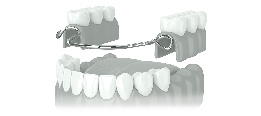 zahnersatz-moeglichkeiten-zahnarzt-dortmund-derne-teilprothesen