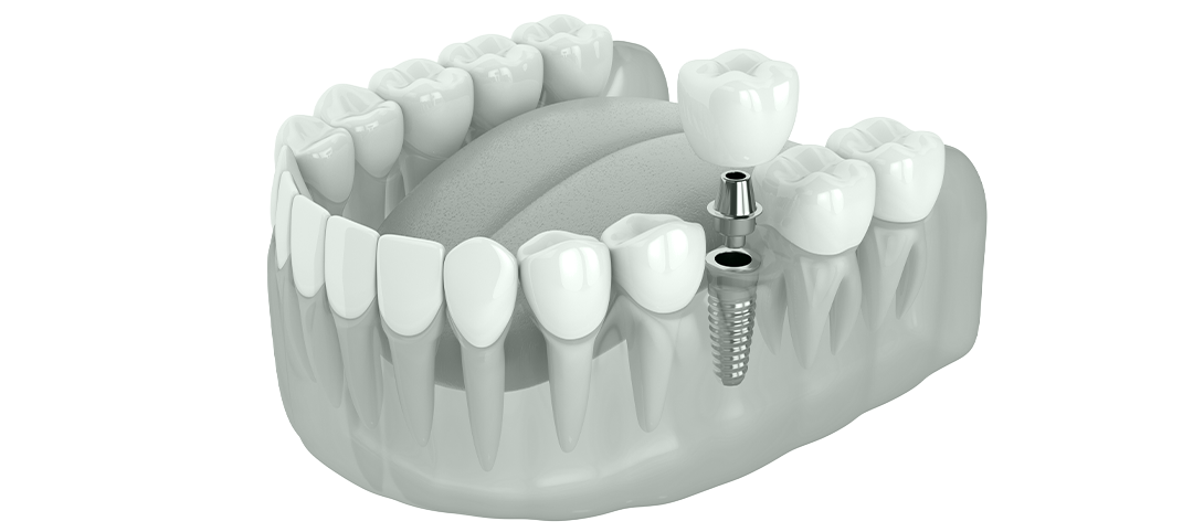 Zahnersatz Krone auf Implantaten visualisiert vom Zahnarzt Anlauf aus Dortmund