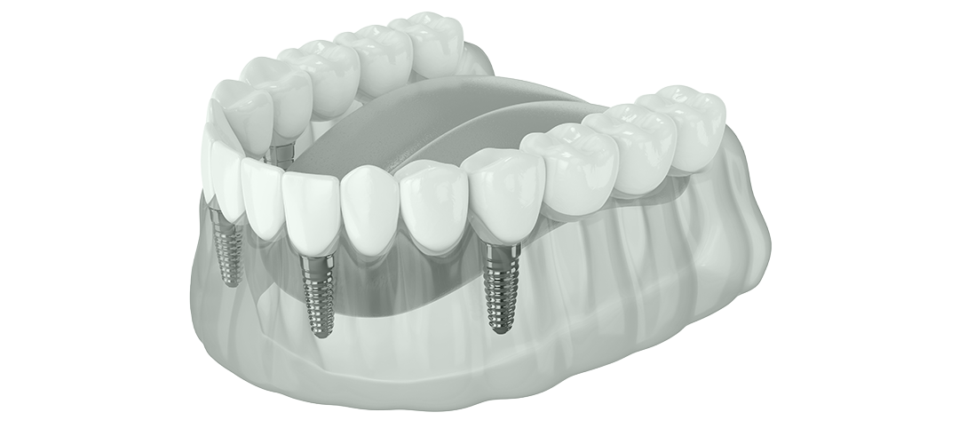 Zahnersatz Prothese auf Implantaten visualisiert vom Zahnarzt Anlauf aus Dortmund