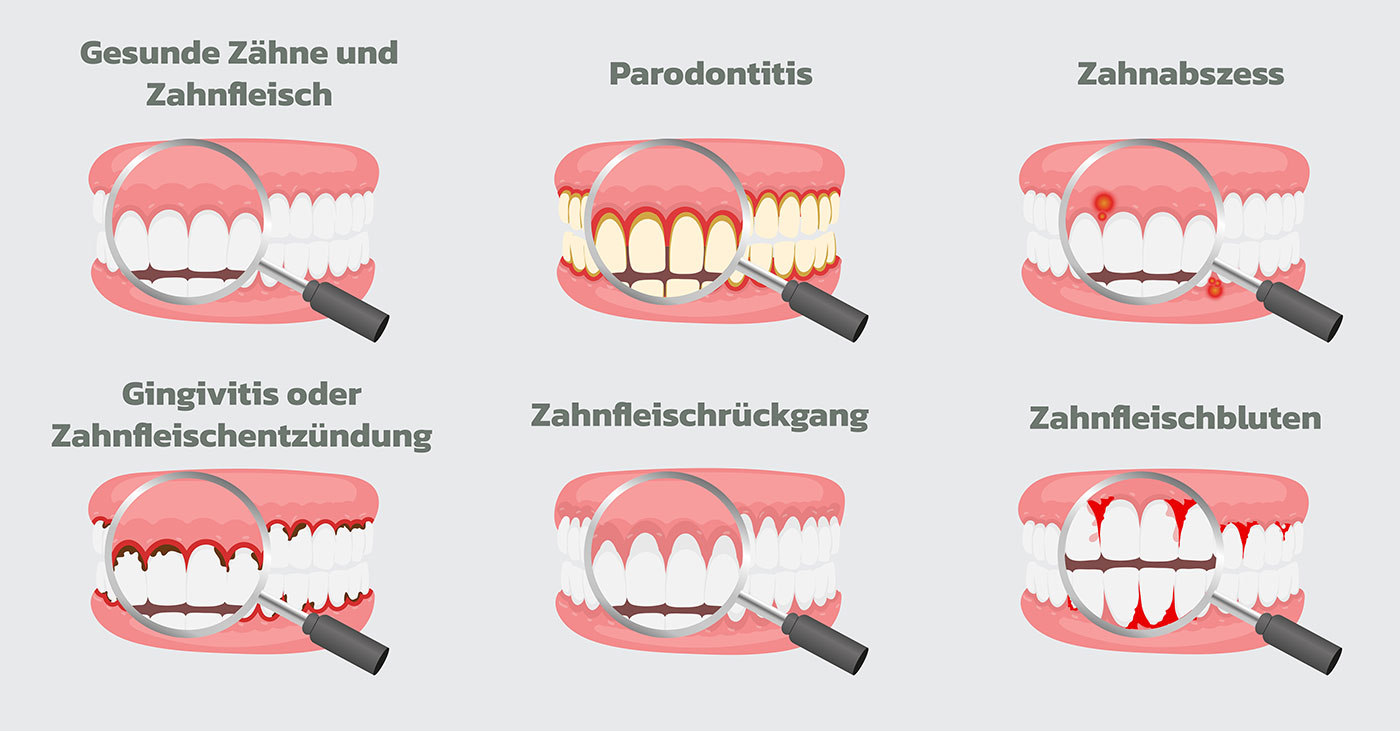 Grafische Abbildung der Zahnarztpraxis Anlauf zu den Entwicklungsstadien von Zahnfleischerkrankungen