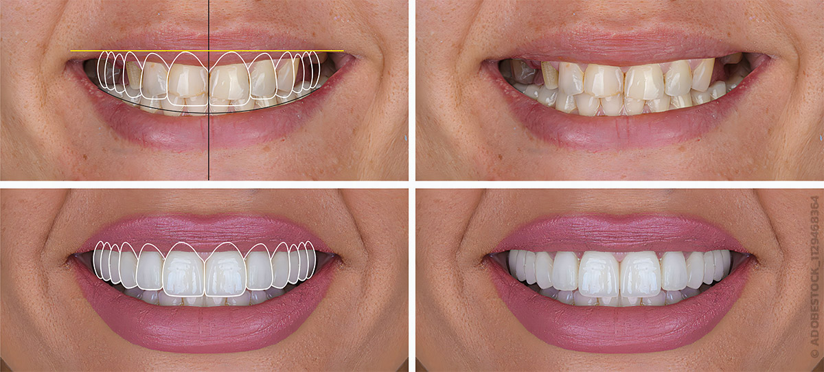 Beispielhafte Abbildung einer Behandlung mit Veneers in 4 Schritten in Dortmund bei der Zahnarztpraxis Anlauf