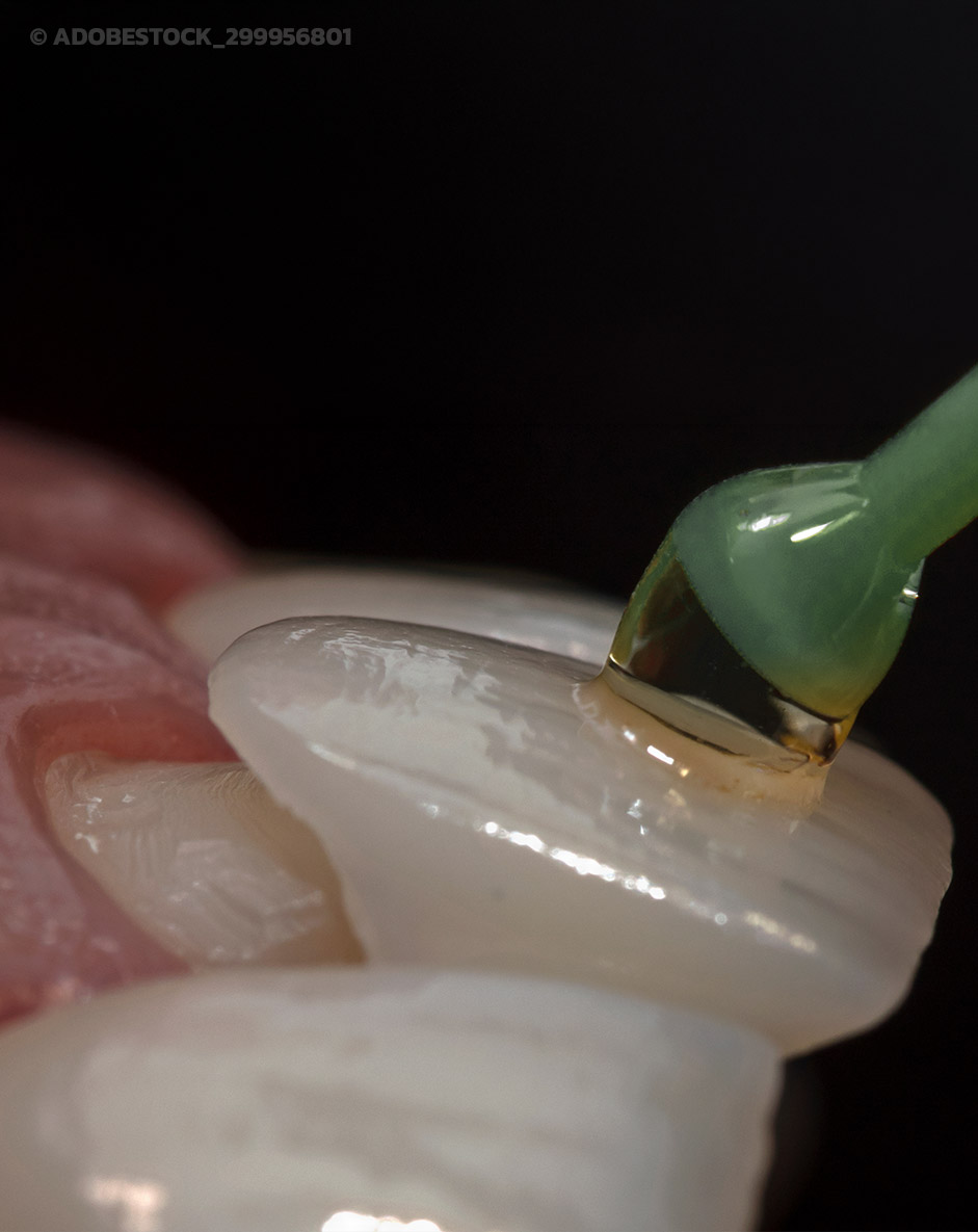 Beispielhafte Abbildung von der Anbringung von Veneers auf den Zähnen in Dortmund bei der Zahnarztpraxis Anlauf